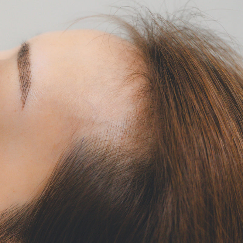 ヘアラインのアートメイク施術中